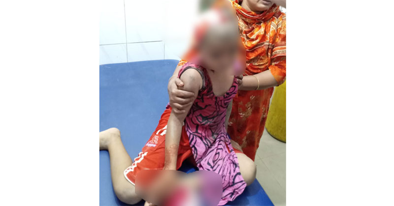 অটো চাপায় শিশুটির মাথার খুলির চামড়া অধিকাংশই আলাদা হয়ে গিয়েছে।
