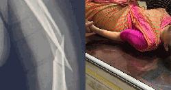 মাঝ আকাশে হাত ভাঙলো কেবিন ক্রুর