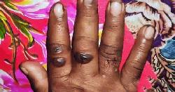 গাইবান্ধার সুন্দরগঞ্জে অ্যানথ্রাক্সের উপসর্গ নিয়ে নারীর মৃত্যু