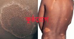 ‘সচেতনতা ও কুসংস্কার দূর করলেই শূন্যে নামবে কুষ্ঠরোগীর সংখ্যা’