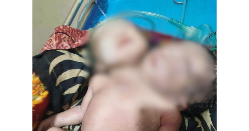 পিরোজপুরের নেছারাবাদে দুই মাথা ও এক দেহবিশিষ্ট বিরল শিশুর জন্ম