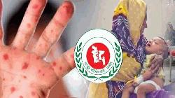 হামে প্রাণ হারাল আরও ২ শিশু